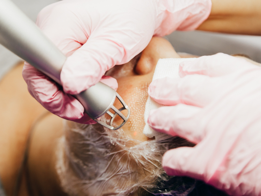 RF-Microneedling oder CO2-Laser – Welche Hautverjüngung passt zu Dir?